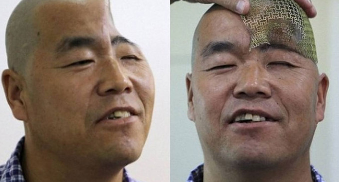 Médicos chinos reconstruirán el cráneo de un hombre con impresoras 3D