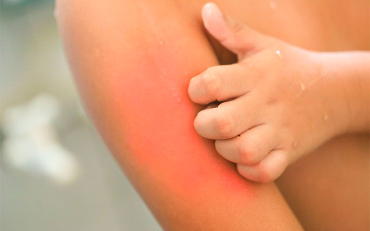 Dermatitis Atópica: una nueva vida es posible